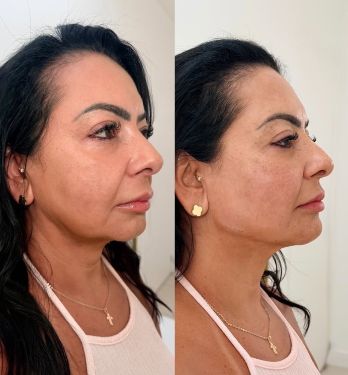 Harmonização Facial