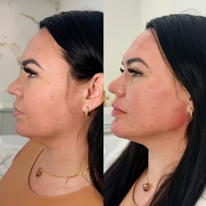 preenchimento mandibular