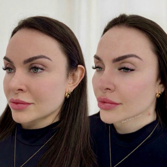 Full Face + Botox